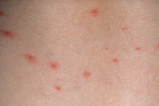 Plané neštovice: příčiny, příznaky a léčba