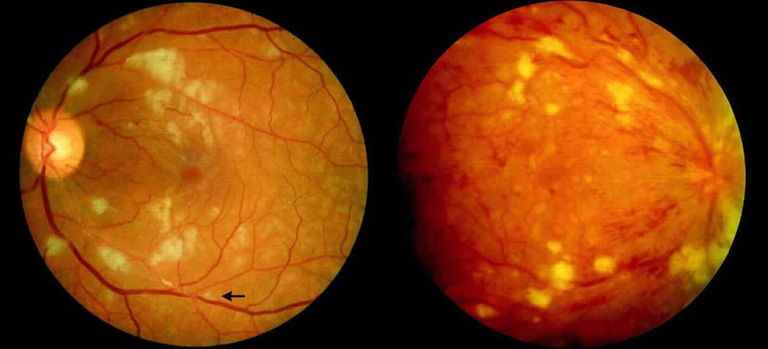 Jak hepatitida B ovlivňuje vaše oči