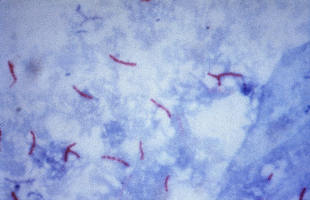 Skvrna Mycobacterium tuberculosis Ziehl-Neelsen 02.jpg
