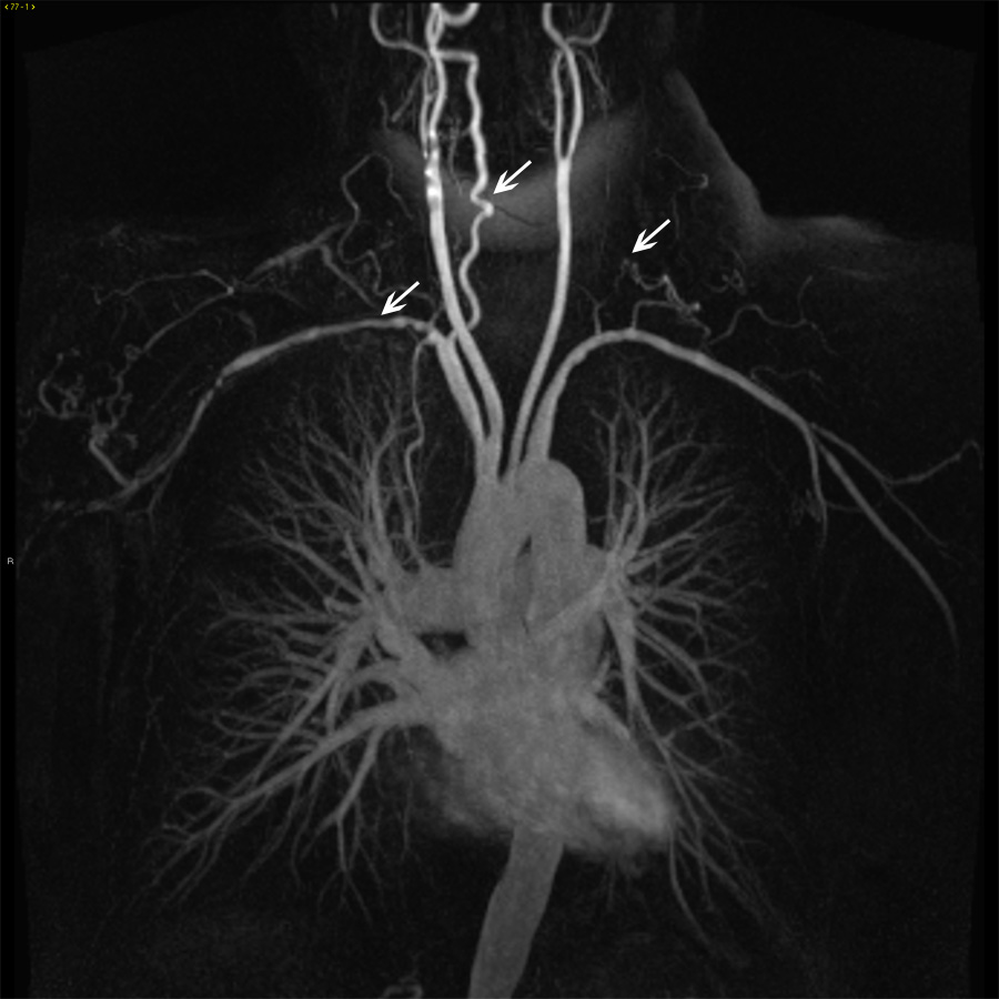 https://www.msdmanuals.com/-/media/manual/professional/images/19a-images-of-aorta-in-takayasu-arteritis-ctisus.jpg?thn=0&sc_lang=cs