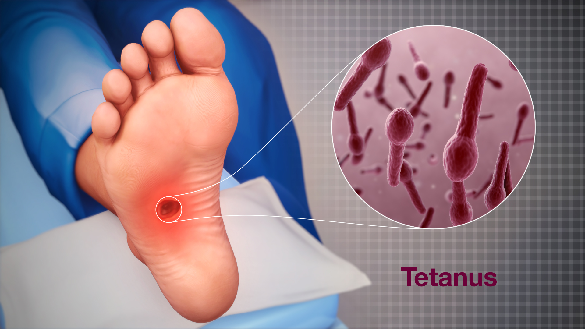Tetanus: příznaky, příčiny a léčba