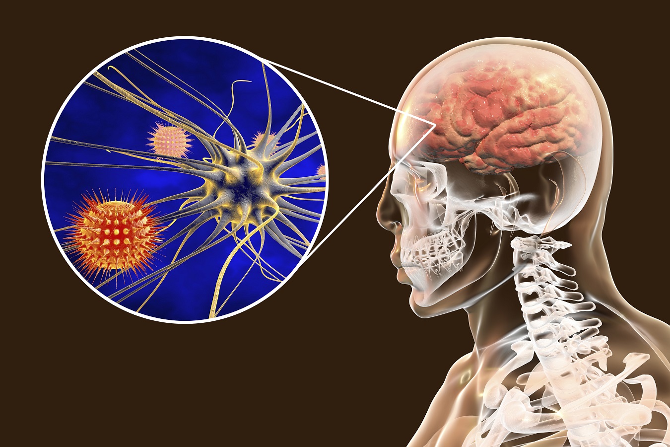 Bakteriální meningitida: příznaky a léčba