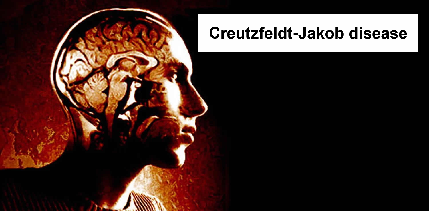 http://medcz.com/wp-content/uploads/2020/12/Creutzfeldt-Jakob-disease.jpg