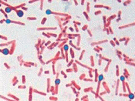 A.  Spory a bakterie Clostridium tetani s typickým tvarem bubnu izolovaného z kůry odrohovatěných ran v případě 1 (barvení gramů - 1000x). 