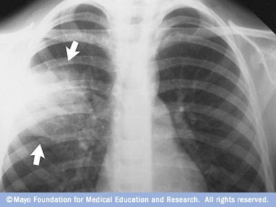 Rentgenový snímek plic s pneumonií