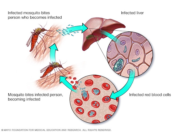 Malárie: příčiny, příznaky a léčba