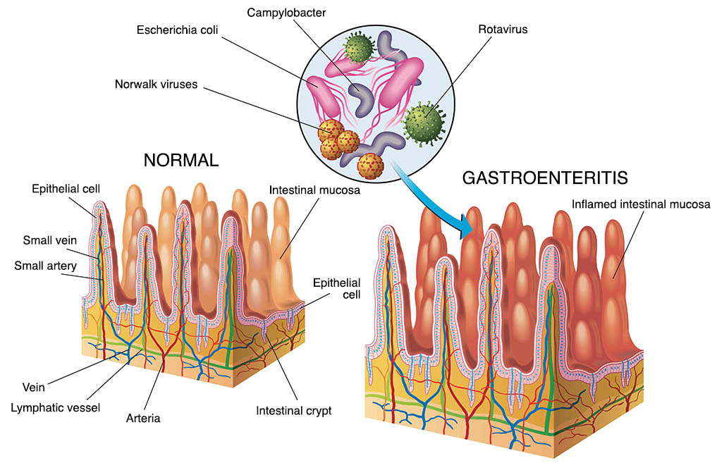 Ilustrace gastroenteritidy