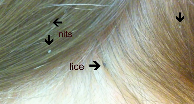 http://medcz.com/wp-content/uploads/2020/12/head-lice-actual.jpg