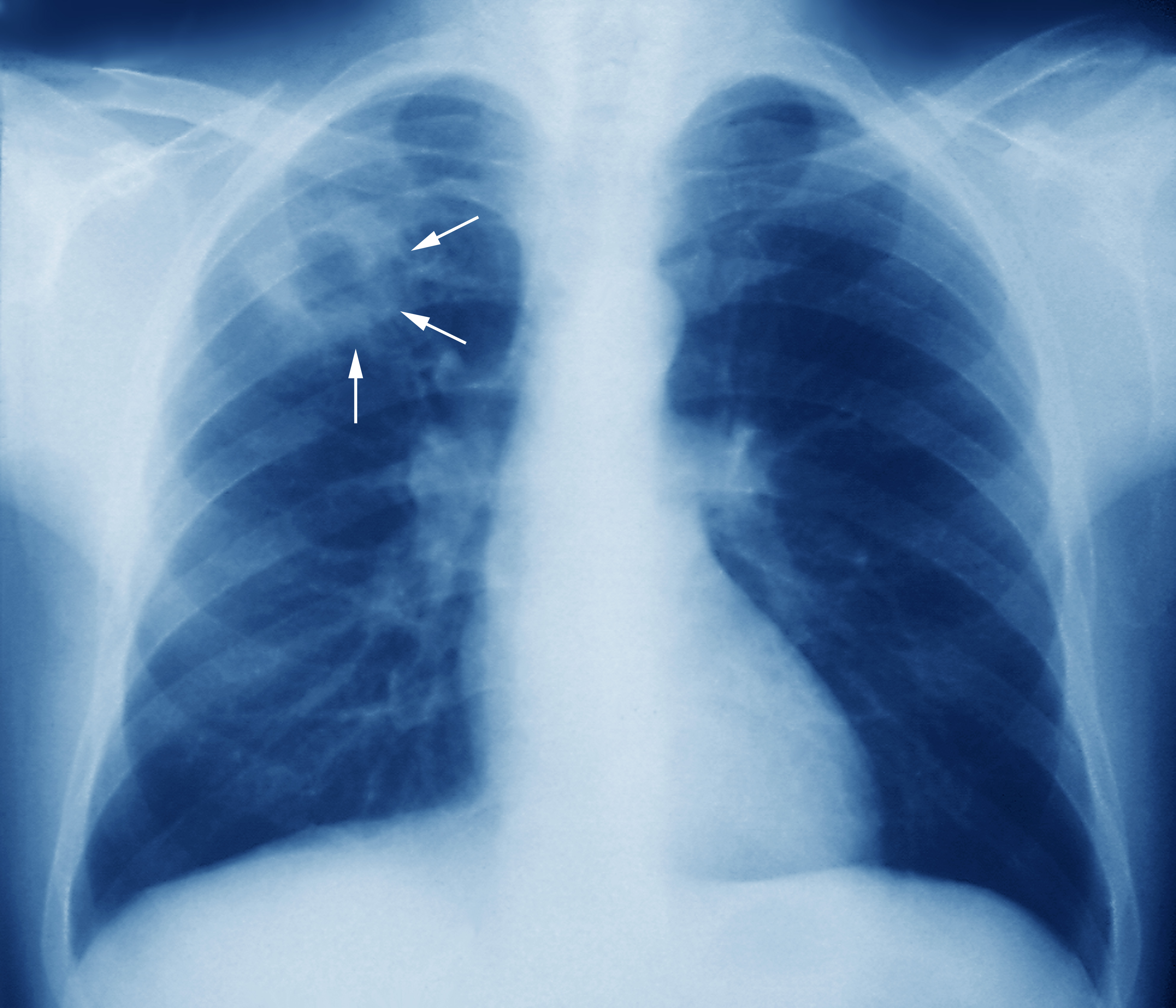 http://medcz.com/wp-content/uploads/2020/12/m2700245-tuberculosis-chest-x-ray-science-photo-library-high.jpg