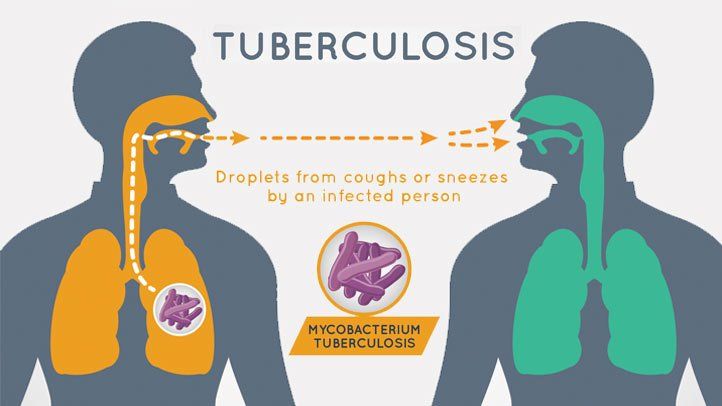 Tuberkulóza: příčiny, příznaky a léčba