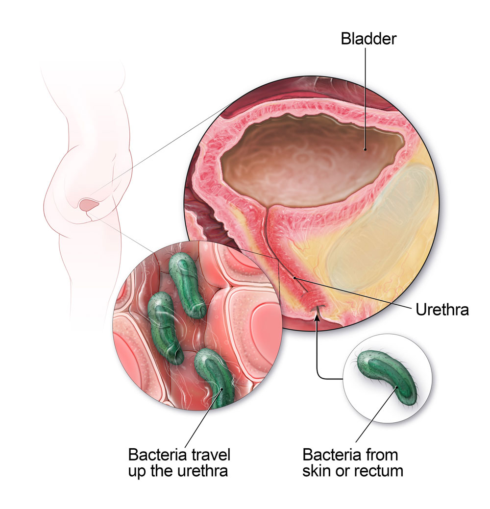 U žen mohou bakterie z kůže nebo konečníku cestovat po močové trubici a způsobit infekci močového měchýře.