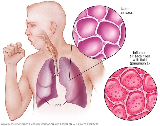 Pneumonie: příčiny, příznaky a léčba