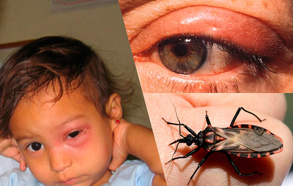 Chagasova choroba: příznaky, příčiny a léčba