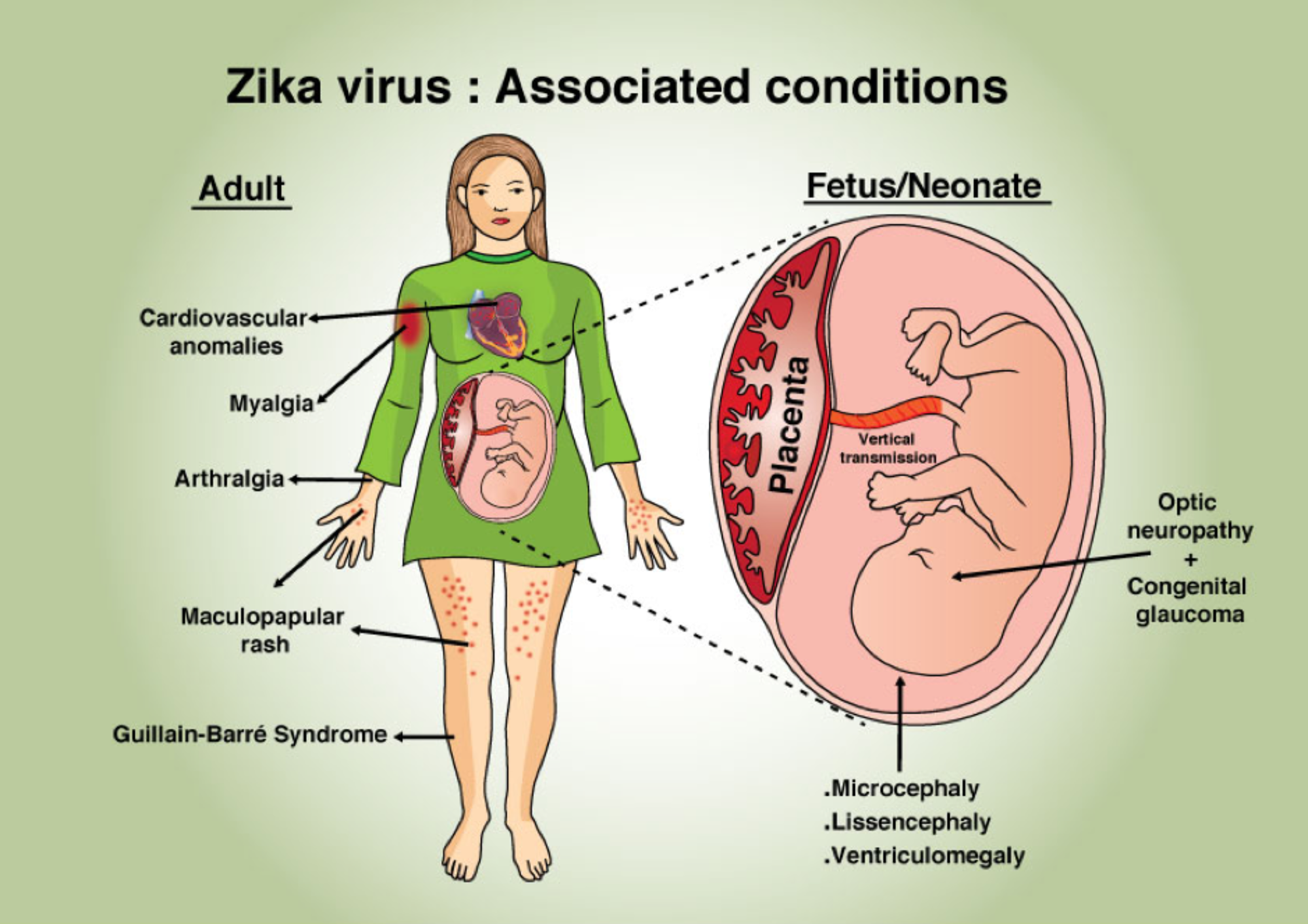 Komplikace z virové infekce Zika